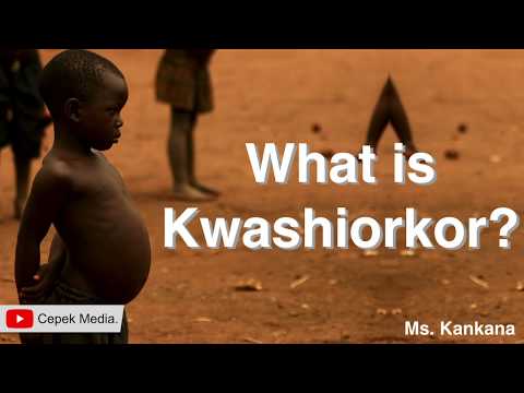 Kwashiorkor: Unmasking Causes, Symptoms, and Diagnosis