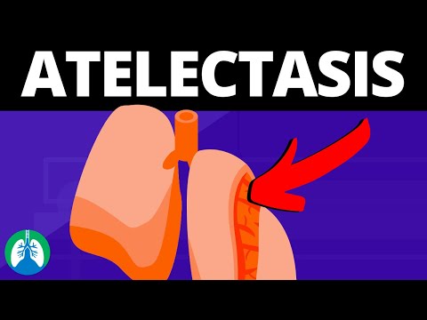 Understanding Atelectasis: Symptoms, Causes, and Treatments