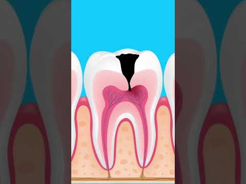 Cavity Clarity: Symptoms, Causes, and Treatments Revealed
