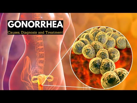 Understanding Gonorrhea: Symptoms, Causes, and Treatment Options