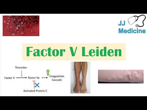 Understanding Factor V Leiden: Symptoms and Diagnosis Explained