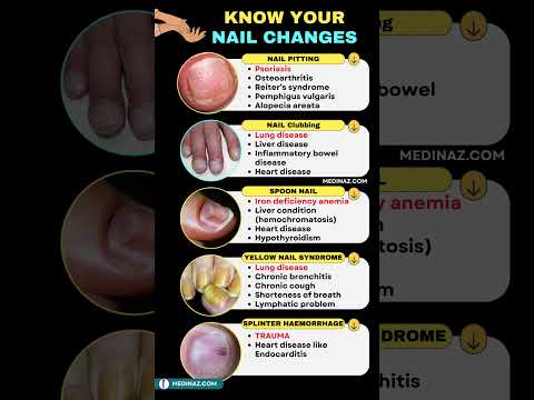 Understanding Terry's Nails: Causes and Effective Treatments