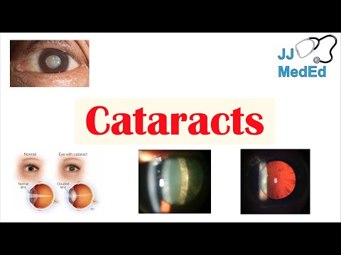Cataracts: Understanding Causes, Symptoms, and Risks