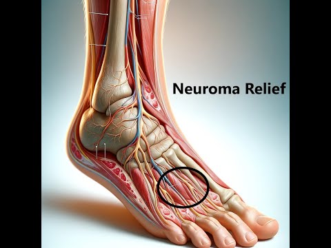 Understanding Morton’s Neuroma: Causes and Treatment Options