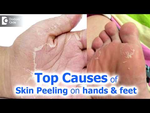 Coping with Peeling Feet: Causes, Symptoms, and Solutions