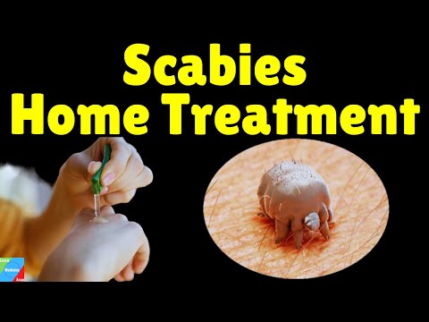 Speed Up Scabies Relief with These Home Remedies post thumbnail image