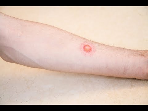 Identifying Ringworm: Symptoms, Signs, and Visuals