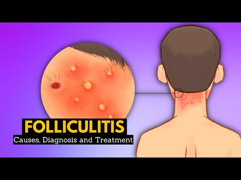 Understanding Eosinophilic Folliculitis: Symptoms and Treatment Options