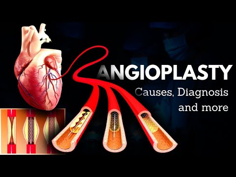 Angioplasty: A Lifeline for Heart Health