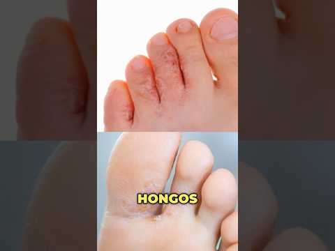 Ampollas en los pies: Causas y soluciones efectivas post thumbnail image