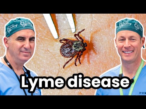 Effective Treatments for Lyme Disease: What You Need to Know