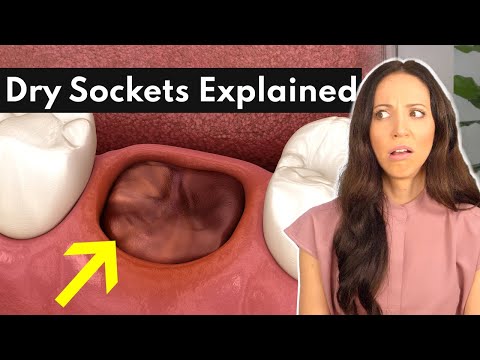 Dry Socket: Recognize Symptoms, Causes, and Remedies