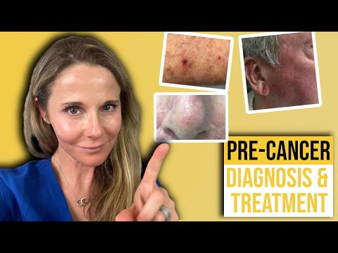 Recognizing and Treating Actinic Keratosis on Your Face