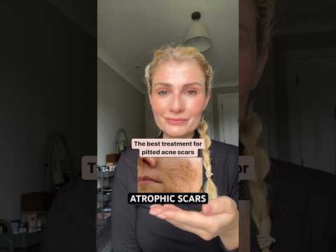 Effective Treatments for Pockmarks: 10 Solutions to Consider post thumbnail image