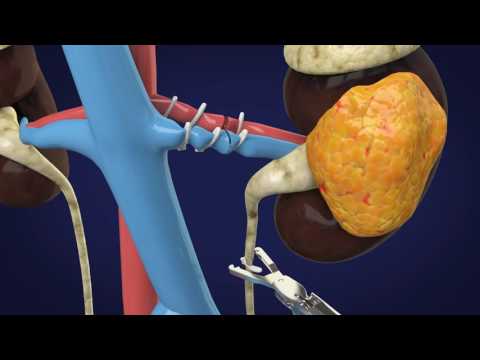 Understanding Kidney Removal: Reasons, Types, and Benefits