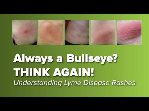Tick Bites: Risks, Symptoms, and Reactions Explained