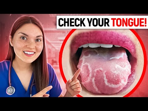 Understanding How HIV Impacts Your Tongue Health post thumbnail image