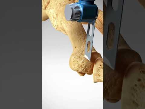 Bunion Pictures: Understanding Causes and Effective Treatments