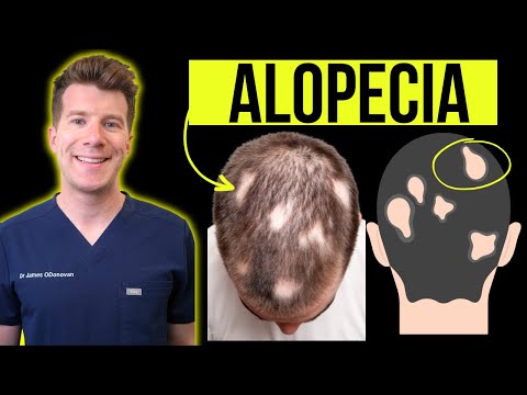 Understanding Alopecia Areata and Its Effects on Hair Loss post thumbnail image
