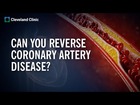 Understanding Atheroma: Causes, Symptoms, and Treatment Options post thumbnail image
