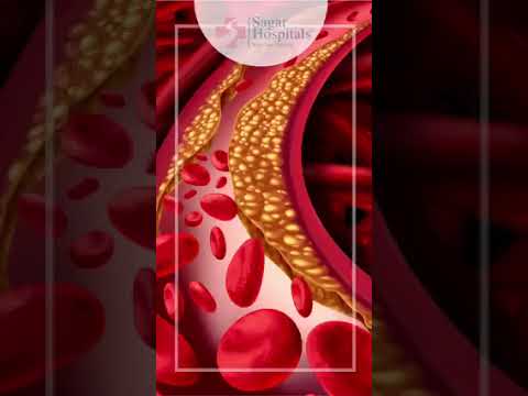 Angioplasty Surgery: Key Insights for Your Heart Health