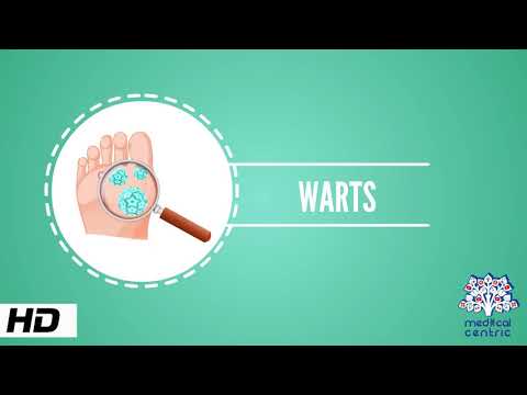 What Causes Common Skin Warts? Understanding Symptoms and Care