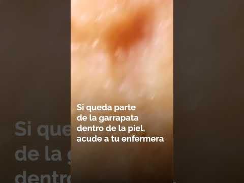 ¿Tienes Picaduras de Ácaros? Señales y Cuidados a Considerar