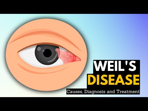 Understanding Weil's Disease: Causes, Symptoms, and Treatments