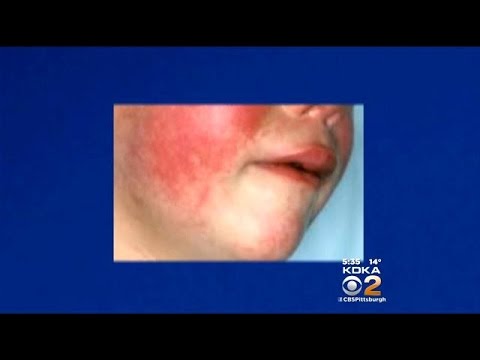 Why Some Diseases Are Making a Comeback Today