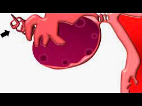 Understanding Ovarian Torsion: Symptoms and Treatment Options
