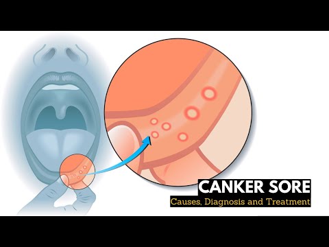 Canker Sores: Causes, Symptoms, and Effective Treatments post thumbnail image