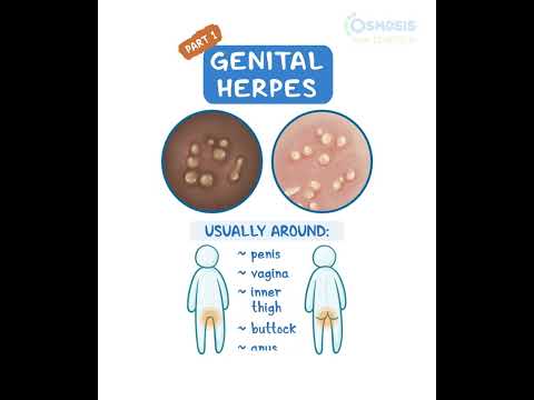 Do HPV and Herpes Resemble Pimples? Find Out Here! post thumbnail image
