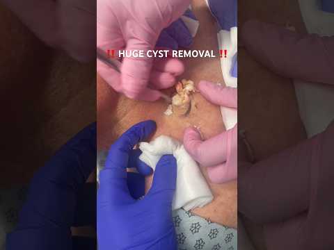 Cysts on Skin: Real Pictures and What to Expect post thumbnail image