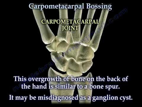 Understanding Carpal Boss: Symptoms and Effective Treatments