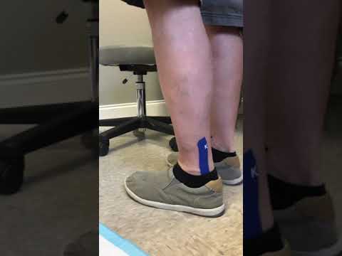 Preparing for Heel Spur Surgery: Recovery and Long-Term Care