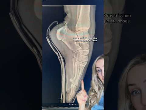 Understanding How Ballet Dancing Impacts Foot Health