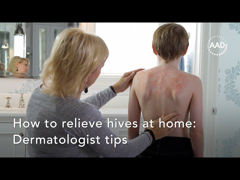 12 Ways to Alleviate Hives Effectively post thumbnail image