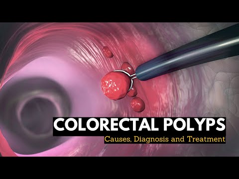 Understanding Treatment for Colon Polyps and Precancerous Conditions