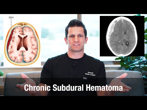 Understanding Chronic Subdural Hematoma: Symptoms and Care