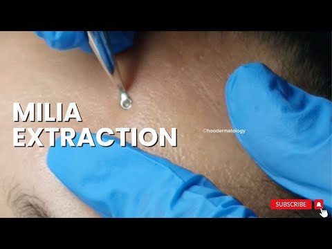 Seven Effective Ways to Banish Milia for Good