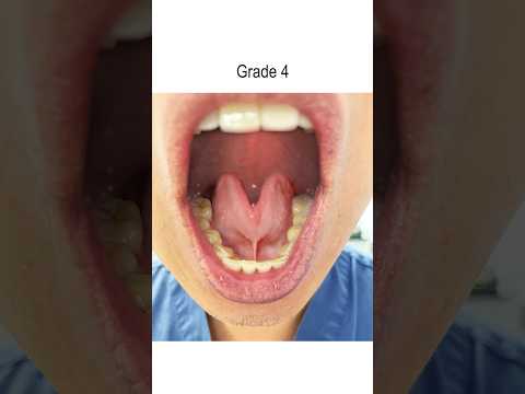 Understanding Posterior Tongue Tie: Symptoms and Treatments post thumbnail image
