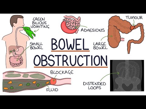 Bowel Obstruction Surgery: Key Insights for Your Health