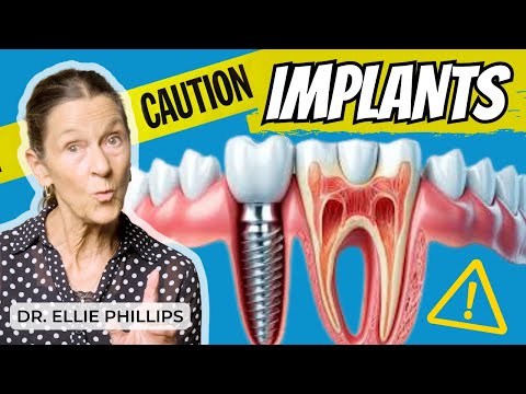 Dental Implants: Benefits, Surgery Details, and Risks