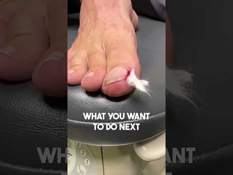 Effective Remedies to Relieve Pain from Ingrown Toenails