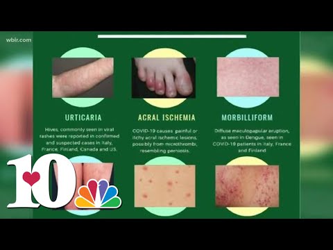 Could Your Rash Signal a COVID-19 Infection?
