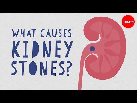 Understanding Kidney Stones: Types and What to Expect