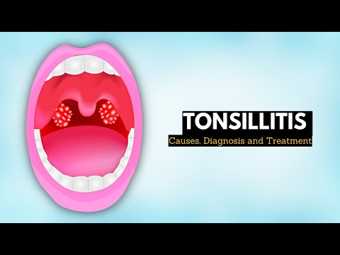 Understanding Adult Tonsillitis: Symptoms and Effective Treatments