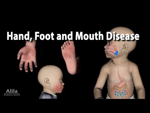 Understanding Hand, Foot, and Mouth Disease in Kids