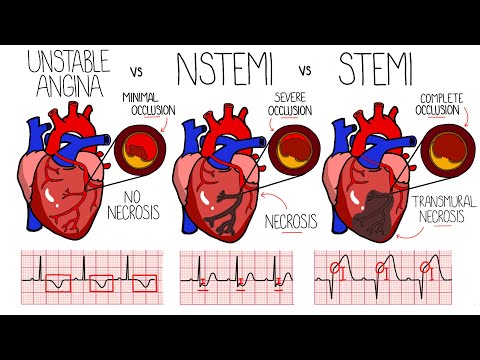 NSTEMI: Understanding Non-ST-Segment Heart Attacks