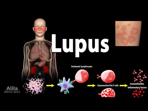 Understanding Lupus and Hives: Symptoms and Effective Treatments post thumbnail image